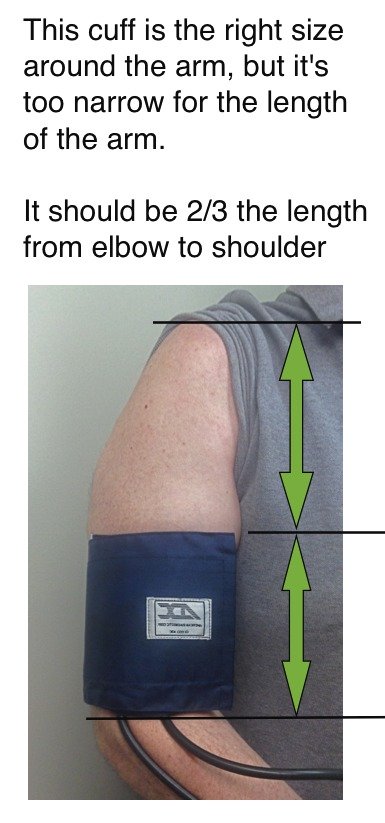 Blood Pressure Cuff Too Narrow Picture